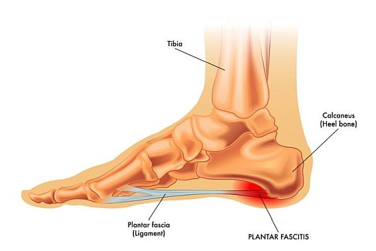 Plantar fascitis illustration